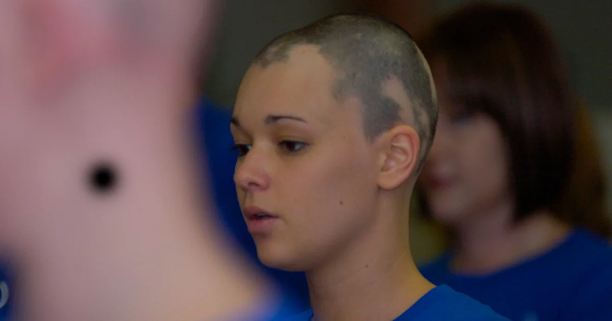 Alopecia areata pode ser desencadeada por fatores emocionais