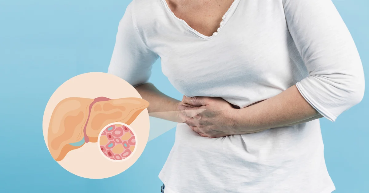 Gordura no fígado: ácido úrico e frutose altos podem desencadear esteatose hepática não alcoólica