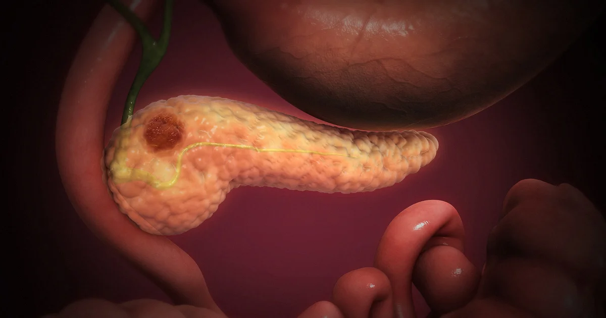 Cientistas identificam genes associados à proliferação de tumores do câncer de pâncreas