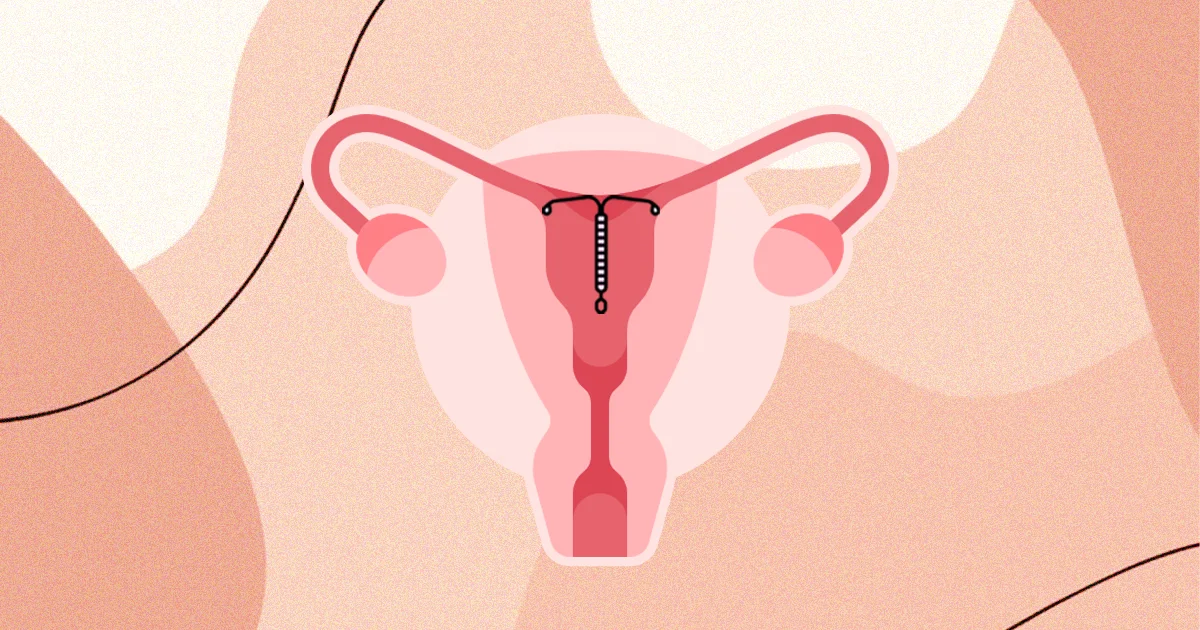 Conheça os LARCs, métodos contraceptivos reversíveis de longa ação