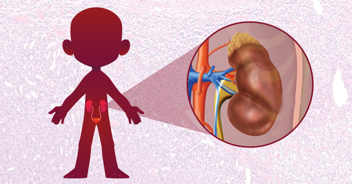 Vitamina D pode estar ligado a tumor da glândula adrenal