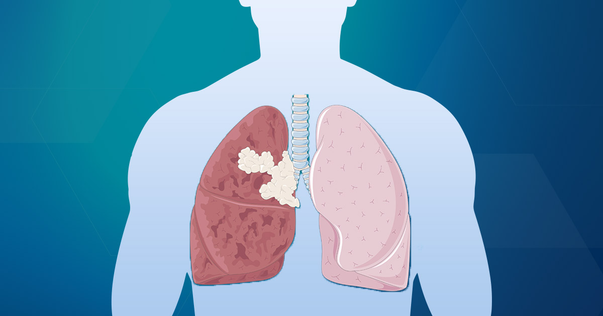Medicamento reduz mortes de pacientes com câncer de pulmão