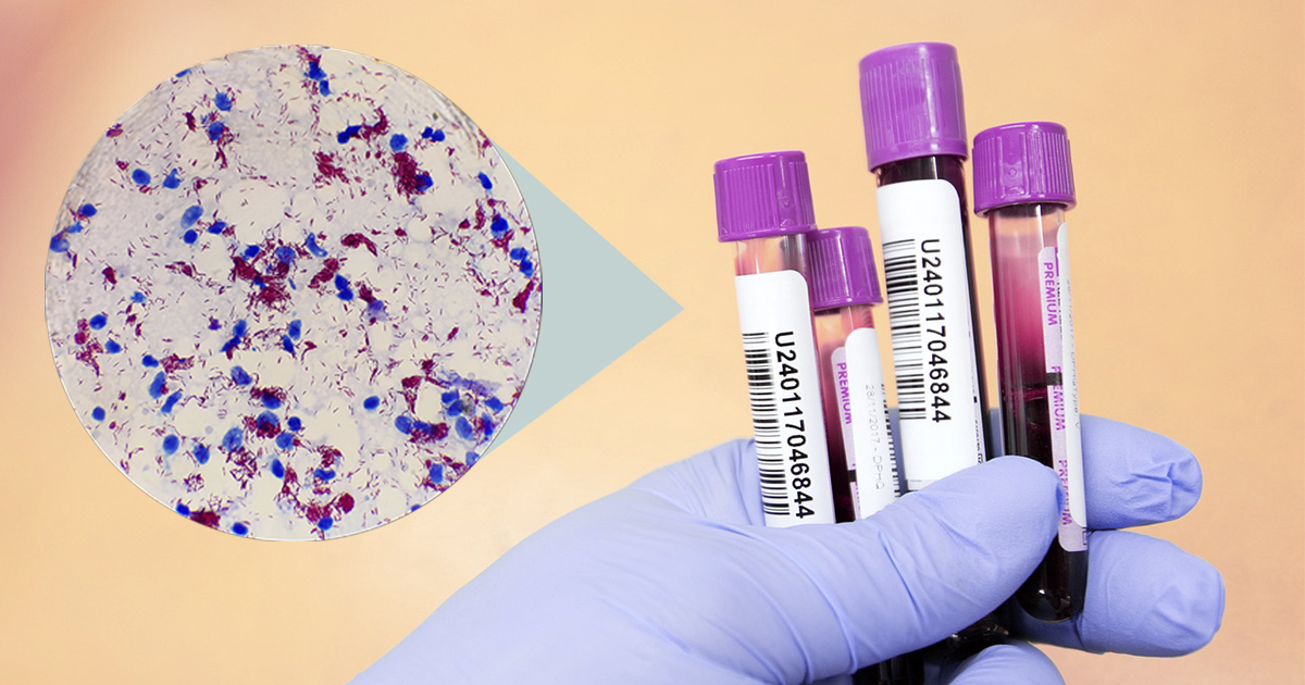 Técnica usa anticorpos do sangue para detectar bactéria causadora da hanseníase