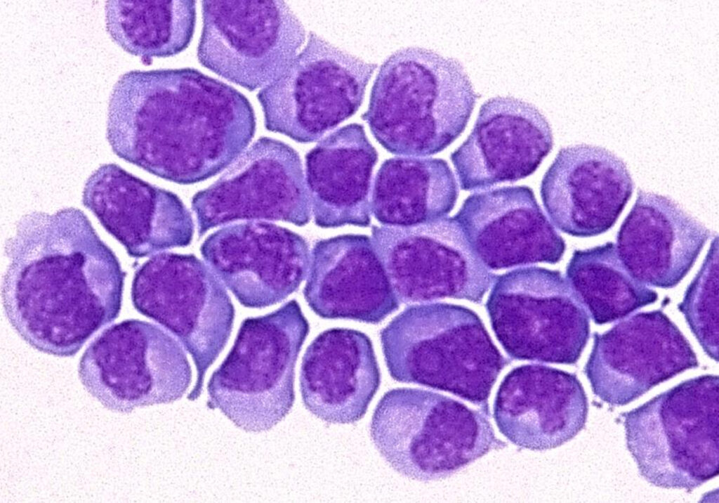 leucemia