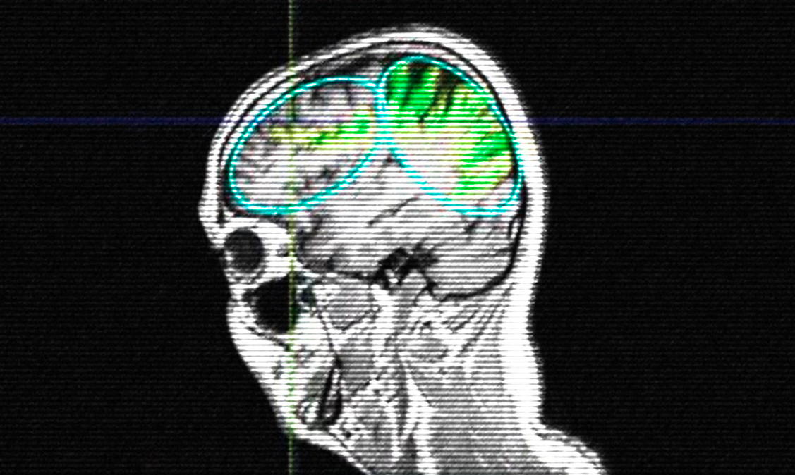 Estimulação transcraniana melhora sintomas do Alzheimer