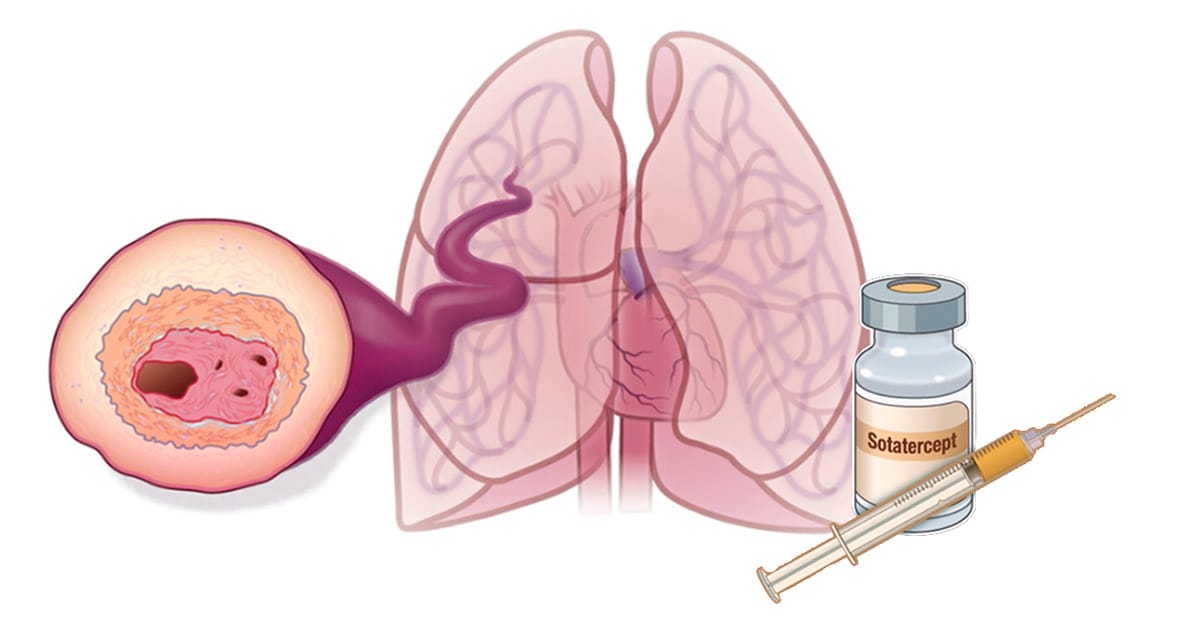 hipertensão arterial pulmonar