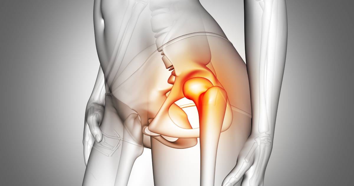 Necrose no quadril: dolorosa, condição pode levar à necessidade de prótese